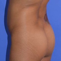 Buttock Augmentation Before & After Patient #7759