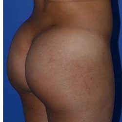 Buttock Augmentation Before & After Patient #7756