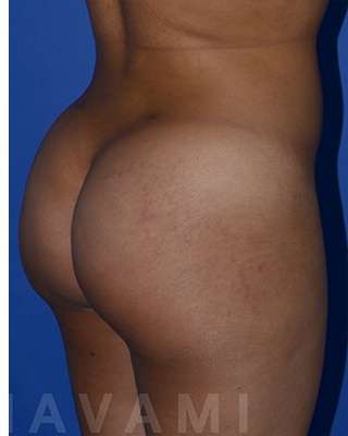 Buttock Augmentation Before & After Patient #7756