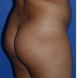Buttock Augmentation Before & After Patient #7756