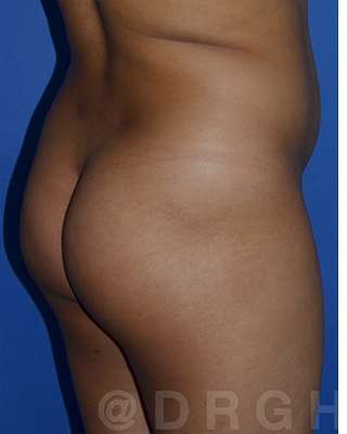 Buttock Augmentation Before & After Patient #7756