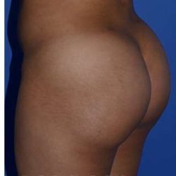 Buttock Augmentation Before & After Patient #7753