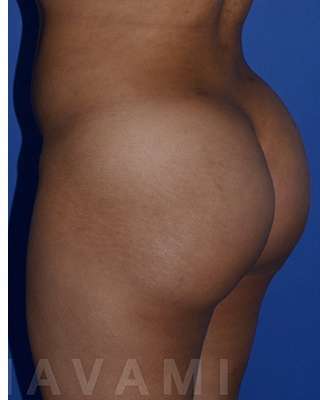 Buttock Augmentation Before & After Patient #7753