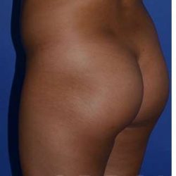 Buttock Augmentation Before & After Patient #7753