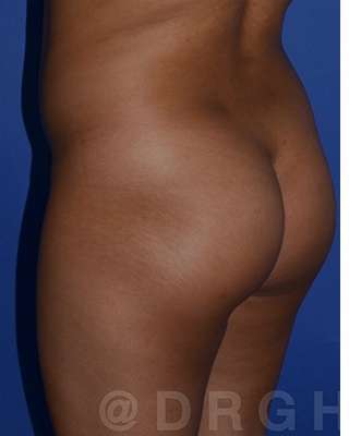 Buttock Augmentation Before & After Patient #7753
