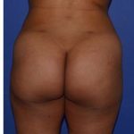 Buttock Augmentation Before & After Patient #7750