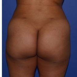 Buttock Augmentation Before & After Patient #7750