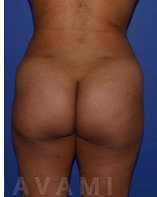 Buttock Augmentation Before & After Patient #7750