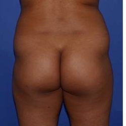 Buttock Augmentation Before & After Patient #7750