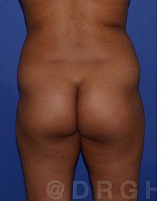 Buttock Augmentation Before & After Patient #7750