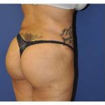 Buttock Augmentation Before & After Patient #7747