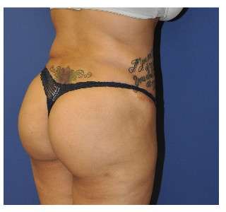 Buttock Augmentation Before & After Patient #7747