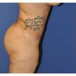 Buttock Augmentation Before & After Patient #7747