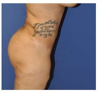 Buttock Augmentation Before & After Patient #7747