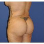 Buttock Augmentation Before & After Patient #7747