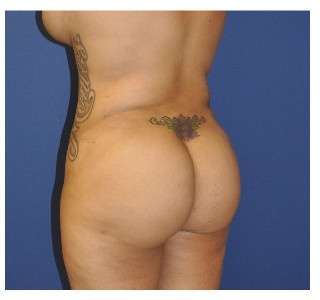 Buttock Augmentation Before & After Patient #7747