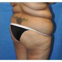 Buttock Augmentation Before & After Patient #7747