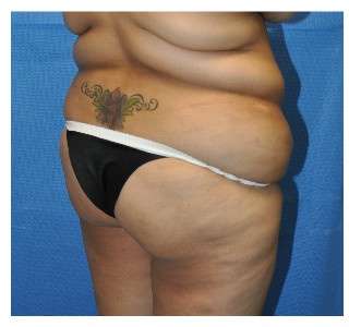 Buttock Augmentation Before & After Patient #7747