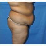 Buttock Augmentation Before & After Patient #7747