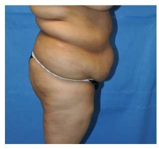 Buttock Augmentation Before & After Patient #7747