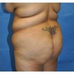 Buttock Augmentation Before & After Patient #7747
