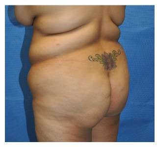 Buttock Augmentation Before & After Patient #7747