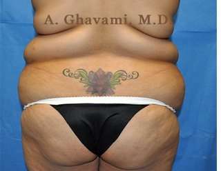 Buttock Augmentation Before & After Patient #7747