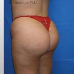 Buttock Augmentation Before & After Patient #7738