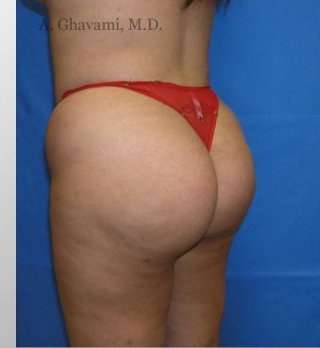 Buttock Augmentation Before & After Patient #7738