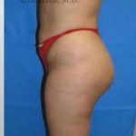 Buttock Augmentation Before & After Patient #7738