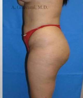Buttock Augmentation Before & After Patient #7738
