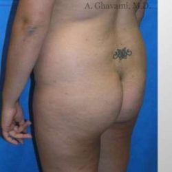 Buttock Augmentation Before & After Patient #7738