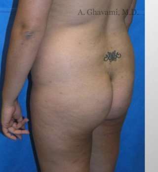 Buttock Augmentation Before & After Patient #7738