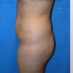 Buttock Augmentation Before & After Patient #7738