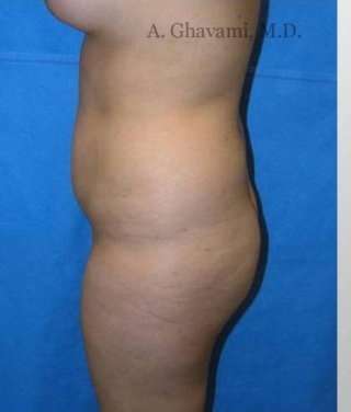 Buttock Augmentation Before & After Patient #7738