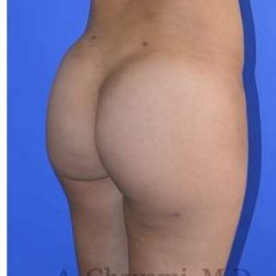 Buttock Augmentation Before & After Patient #7733