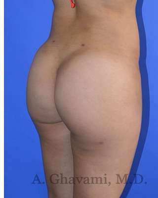 Buttock Augmentation Before & After Patient #7733
