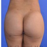 Buttock Augmentation Before & After Patient #7733