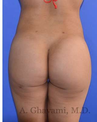 Buttock Augmentation Before & After Patient #7733