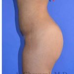 Buttock Augmentation Before & After Patient #7733