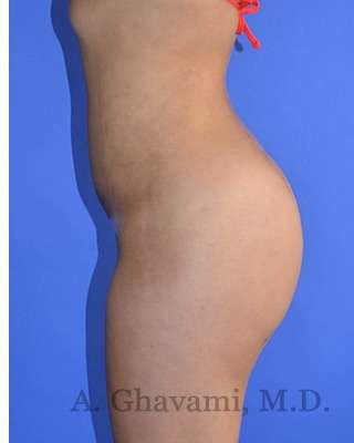 Buttock Augmentation Before & After Patient #7733