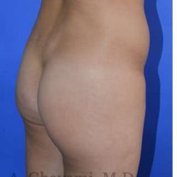 Buttock Augmentation Before & After Patient #7733