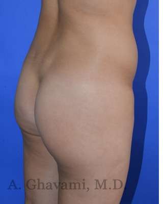 Buttock Augmentation Before & After Patient #7733