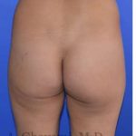 Buttock Augmentation Before & After Patient #7733