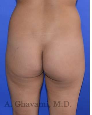 Buttock Augmentation Before & After Patient #7733