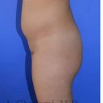 Buttock Augmentation Before & After Patient #7733