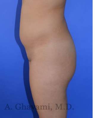Buttock Augmentation Before & After Patient #7733