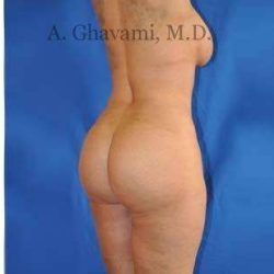 Buttock Augmentation Before & After Patient #7726