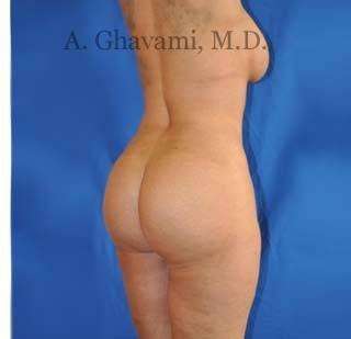 Buttock Augmentation Before & After Patient #7726