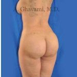 Buttock Augmentation Before & After Patient #7726